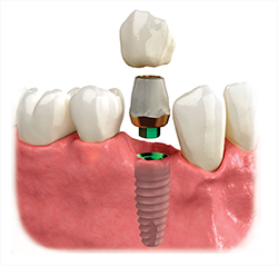 Dental Implant Melbourne