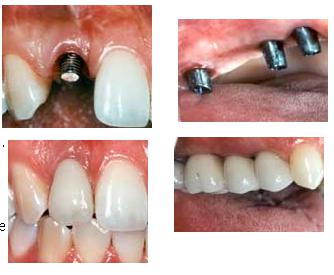 Dental Implant Melbourne