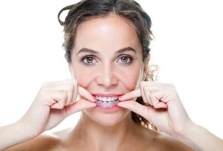 Invisalign Treatment Melbourne