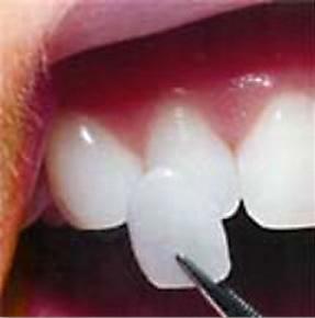 Porcelain Veneers Melbourne