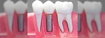 Dental implants