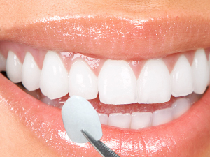 Porcelain Veneers Melbourne