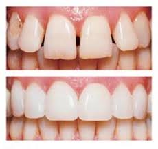 Porcelain Veneers