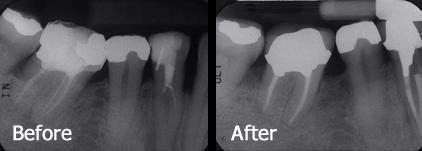 Before and After Root Canal Treatment