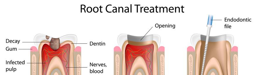 Root Canal Treatment