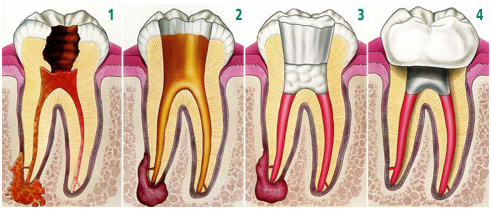 Root Canal Treatment