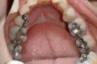 Amalgam fillings