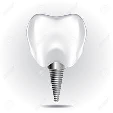 Dental Implant