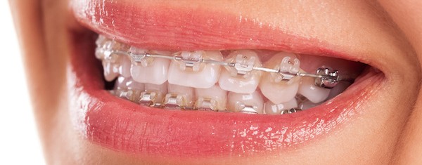 Orthodontics Melbourne