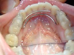 TMJ Treatment