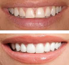 Cosmetic Dentistry Melbourne