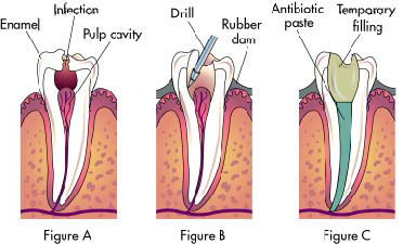 Root canal treatment