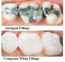 Amalgam Fillings