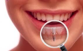 Dental Implant Melbourne