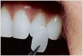 Porcelain Veneers Melbourne