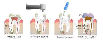 Root Canal Treatment