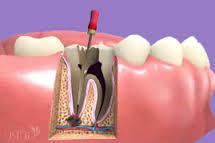 Root Canal Treatment