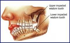 Wisdom Teeth Removal