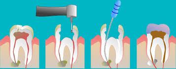 Root Canal Treatment