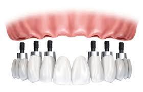 Dental Implants Melbourne