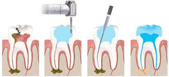 Root Canal Treatment