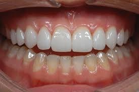 Porcelain Veneers Melbourne