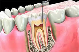 Root Canal Treatment