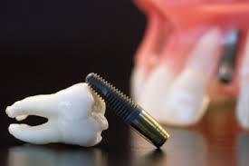 Dental Implants Melbourne