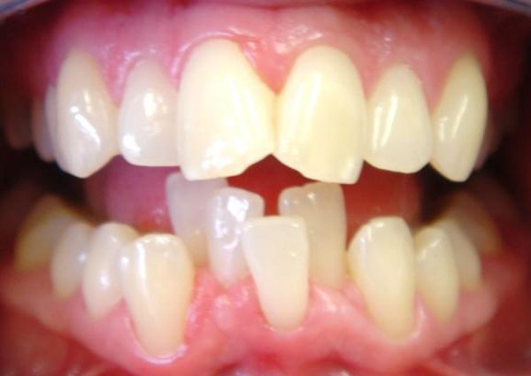 Dental Irregularities Correction
