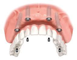 Dental Implant Melbourne