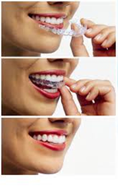 Invisalign Melbourne