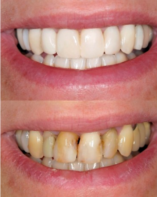 Porcelain Veneers in Melbourne