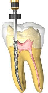 Root Canal Treatment