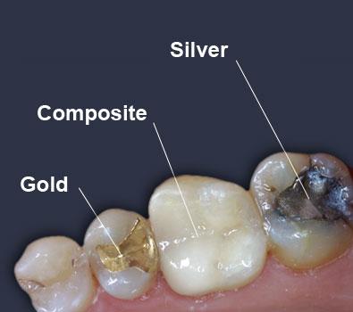 Teeth Damage Restoration