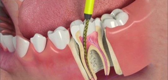 root-canal-therepy