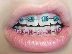 Dental Braces