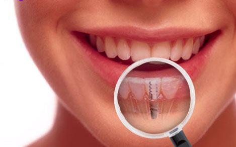 Dental Implants