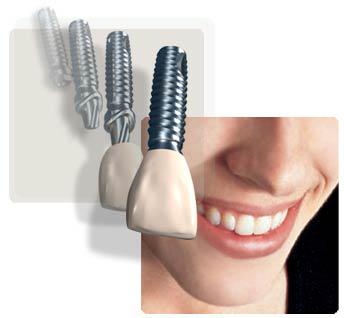 Dental Implant Melbourne