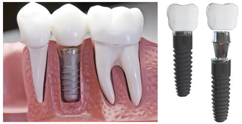 Dental Implants Melbourne