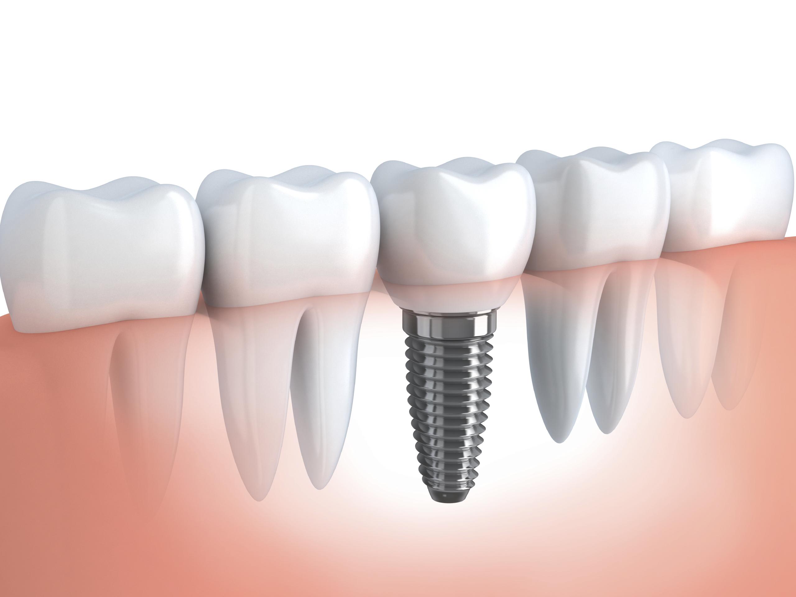 Dental Implants Melbourne