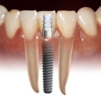 Dental Implant Melbourne