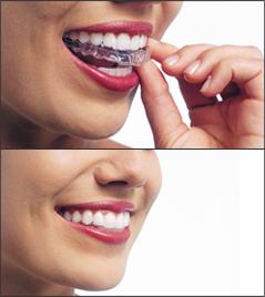 Invisalign Treatment