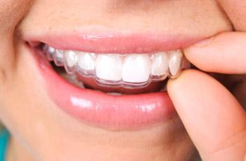 Invisalign Treatment