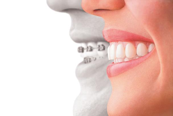 Invisalign Melbourne