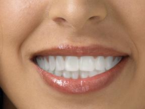 Invisalign Melbourne