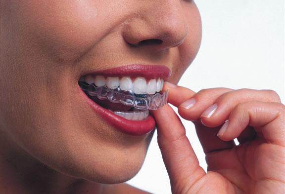 Invisalign Melbourne