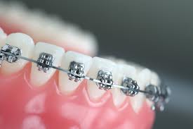 Orthodontics Melbourne