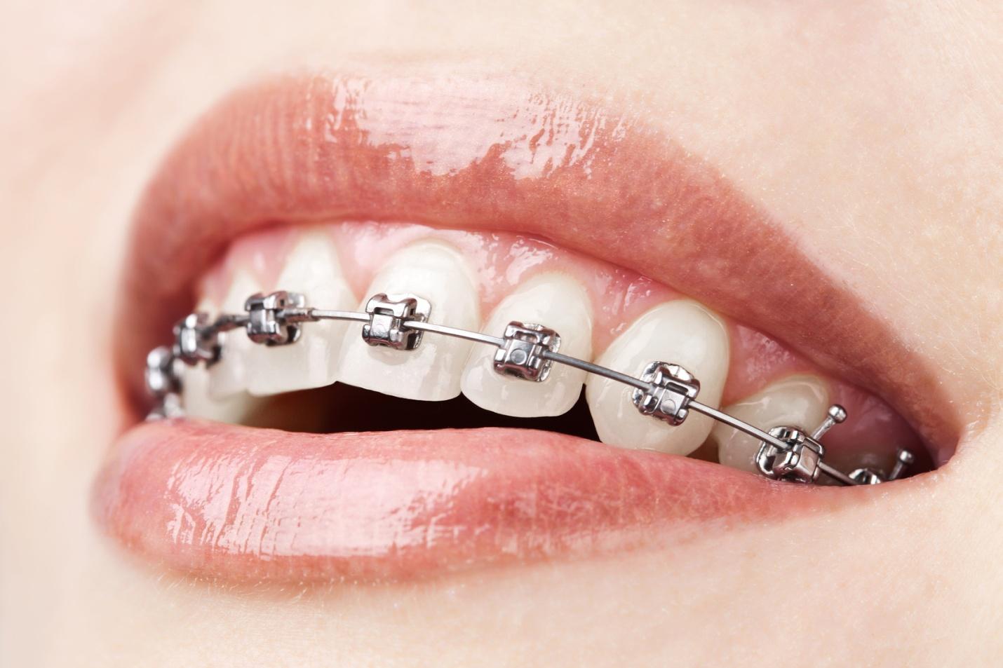 Orthodontics Melbourne