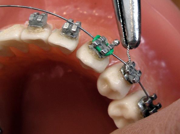 Orthodontic Treatment