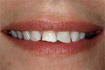 Before Porcelain Veneers